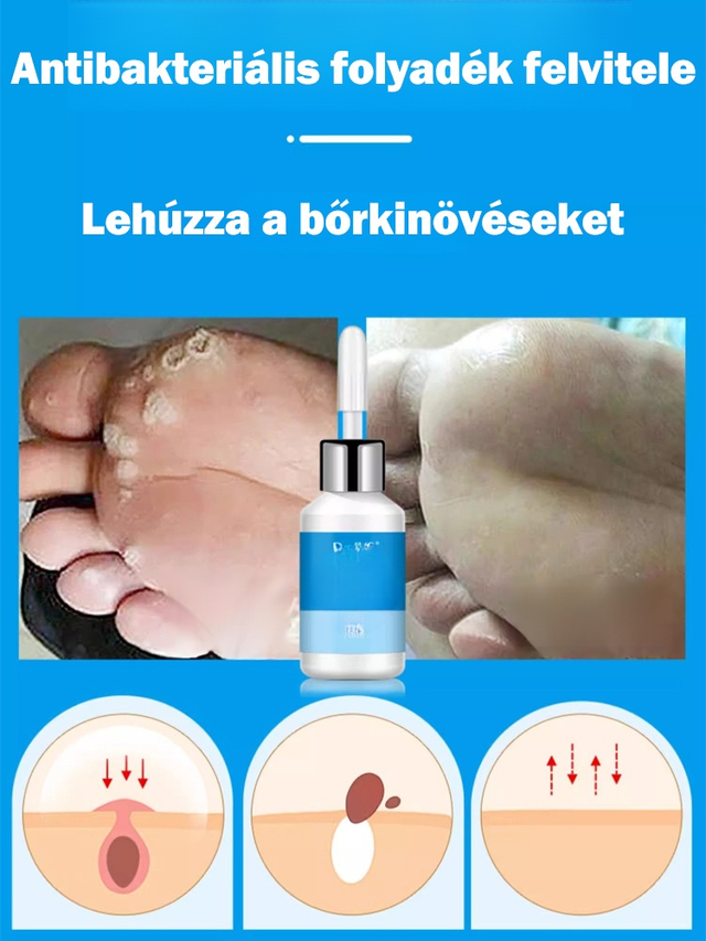 Tyúkszem eltávolító folyadék