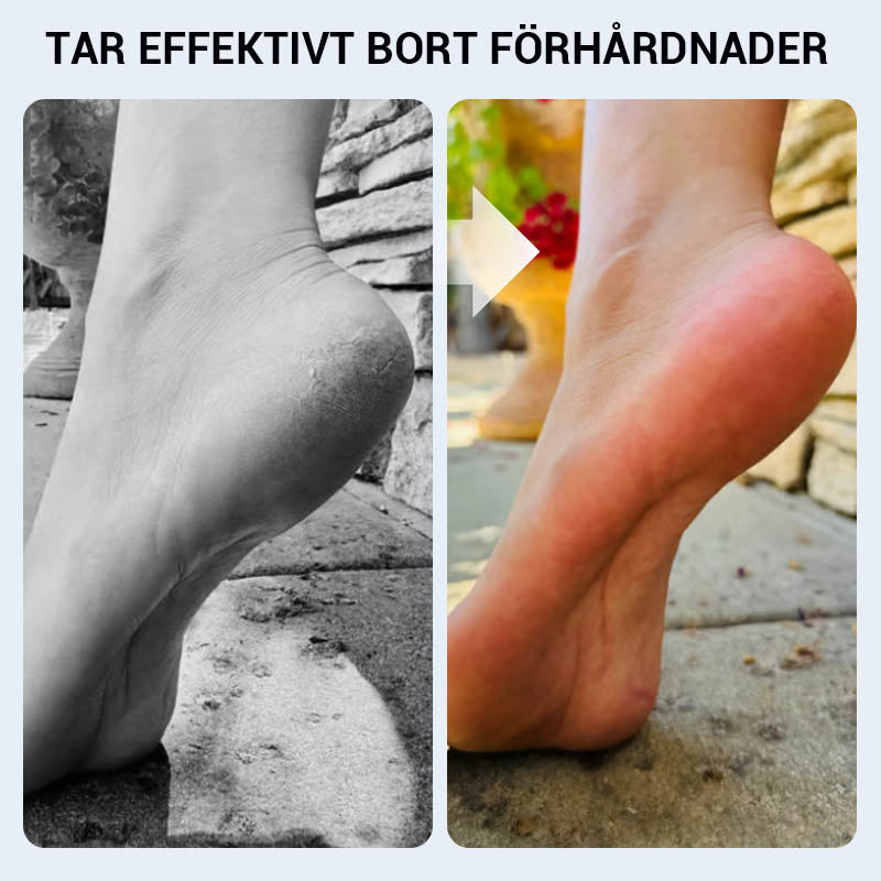 🔥 Praktikus kézi bőrkeményedés eltávolító a lábfejhez🦶🏻