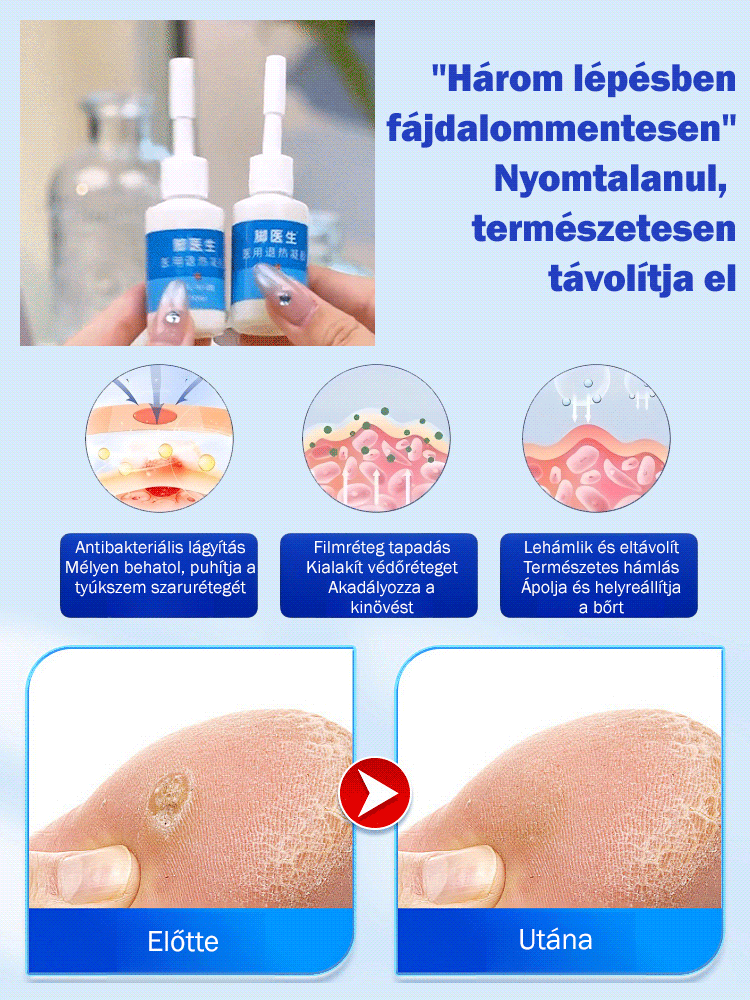 Tyúkszem eltávolító folyadék